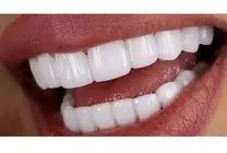 خداحافظی با دندان های زرد به کمک روغن نارگیل! + طرز استفاده