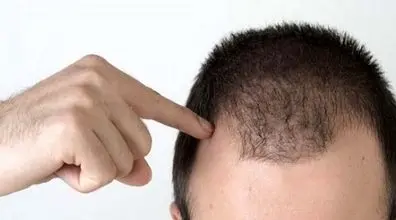 سریع ترین روش طبیعی رشد مو کشف شد | فواید کدو تنبل در رشد مو + توضیحات