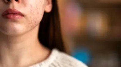 این 10 عادت به پوستت آسیب می رسونن!! | روش های جلوگیری از آسیب های پوستی!