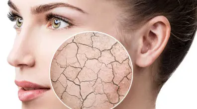 علت و رفع خشکی پوست در زمستان + 12 روش 