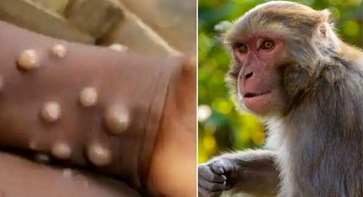 بیماری آبله میمون