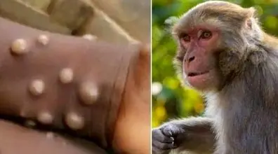 همه چیز درباره آبله میمون | علائم بیماری آبله میمون چیست؟