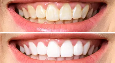 سفید کردن دندان با چند روش ساده خانگی | خیلی راحت و ساده دندوناتو سفید و جذاب کن