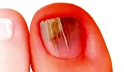  علت ترک روی ناخن چیست؟ 