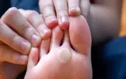 میخچه کف پا رو با روش های خانگی درمان کن + نکات 