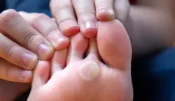 میخچه کف پا رو با روش های خانگی درمان کن + نکات 