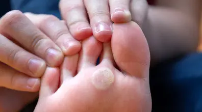 میخچه کف پا رو با روش های خانگی درمان کن + نکات 