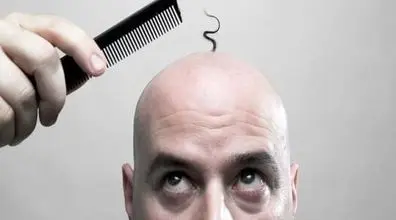 اگه این قسمت از موهات میریزه؛ قراره سکته کنی!!! | عوارض جدی ریزش مو 