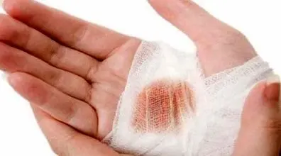 بهترین روش خانگی برای بند اومدن خونریزی زخم