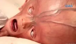 (ویدیو) تولد نوزاد عجیبی که بزرگترین سر دنیا رو داره + عکس