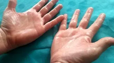 چرا کف دستم عرق می کنه؟ | درمان خانگی تعریق کف دست و پا 