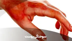 اگه سوختگی رو اینجوری درمان کنی دیگه جاش نمیمونه!