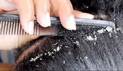 شوره موهات رو با جوش شیرین از بین ببر | روش خانگی برای رفع شوره شر