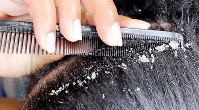 شوره موهات رو با جوش شیرین از بین ببر | روش خانگی برای رفع شوره شر