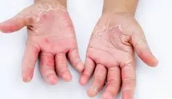 چرا دستم پوست پوست میشه؟ + روش درمان 