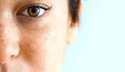 درمان و جلوگیری از بروز لک صورت در دوران بارداری + علت 